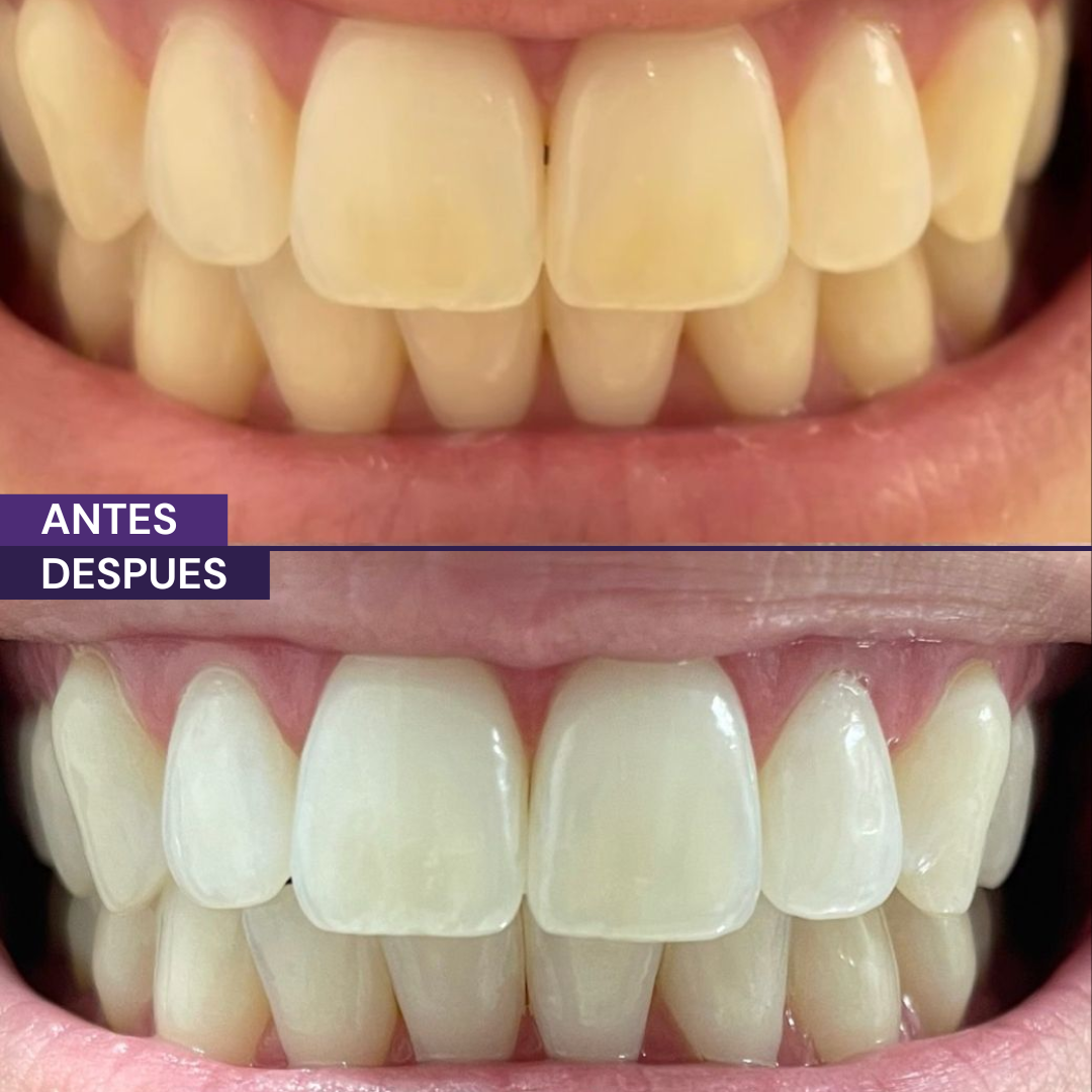 Bandas blanqueadoras Whitening Pro™